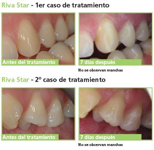 Riva Star Desensibilizante